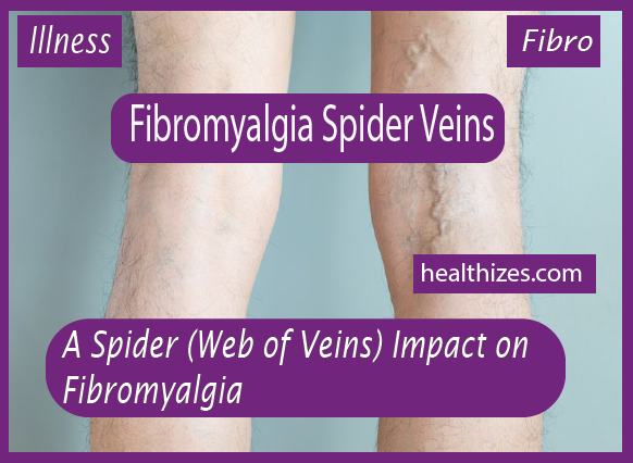 A Spider (Web of Veins) Impact on Fibromyalgia