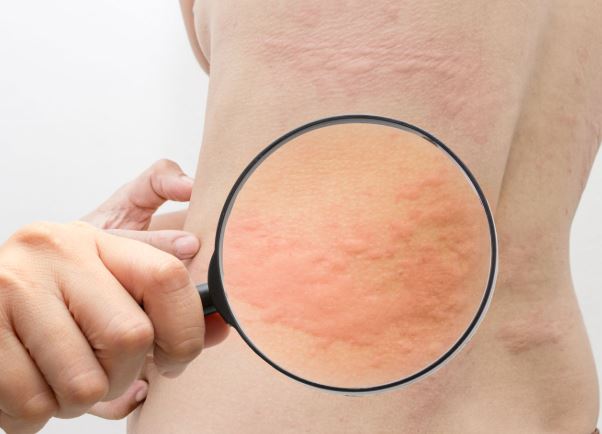 What Causes Urticaria? How It is Linked With Fibromyalgia