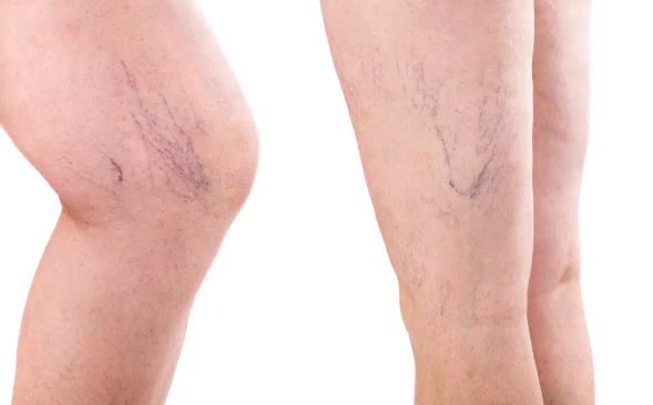 How Fibromyalgia make Varicose Veins more Intense