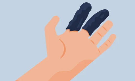 Panic Situation due to Raynaud’s Syndrome and Fibromyalgia