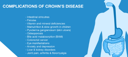 Why Fibromyalgia and Crohn’s Illness is Connected?