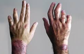 Faced with the Challenges of Dual Psoriatic Arthritis Diagnosis