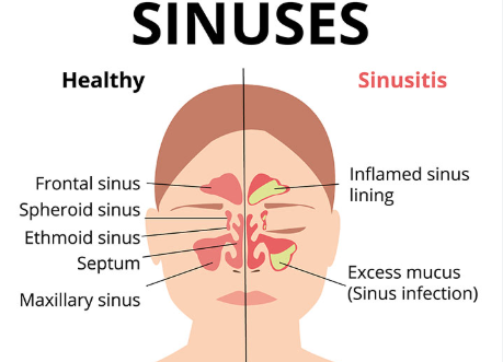 Spring and Sinusitis: How they Affected with fibromyalgia?