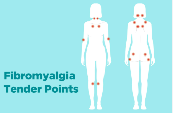 Most Significant Tendering Points for Fibromyalgia Management