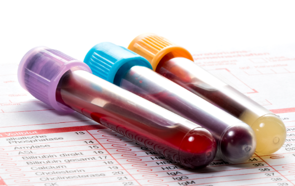 New Fibromyalgia blood test is 99% accurate