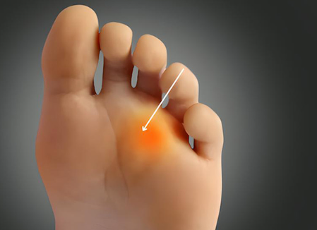 Morton’s Neuroma and Fibromyalgia. Are they Both Related?