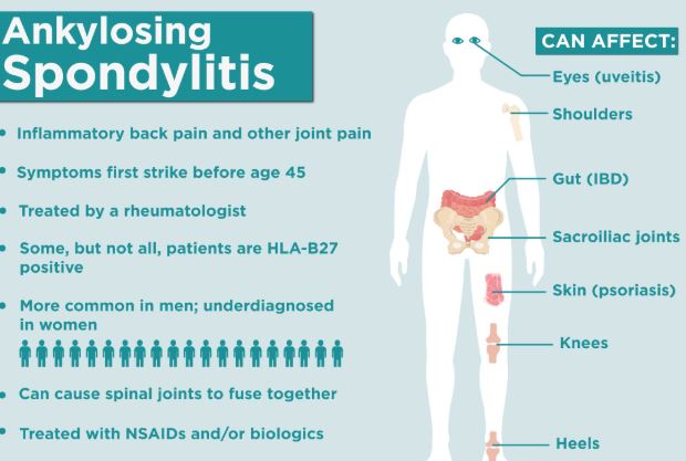 How Fibromyalgia Increases the Symptoms Ankylosing Spondylitis