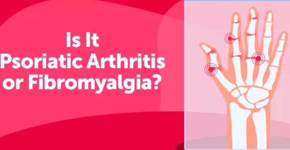 Should We Treat Fibromyalgia and Psoriatic Arthritis Together