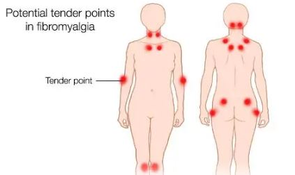 18 Conscious Pressure Points for Fibromyalgia Every Suffer Needs to Aware