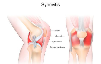 Fibromyalgia is Getting More Worst when you are Facing Synovitis