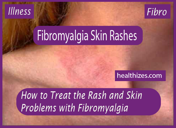 How to Treat Rash and Skin Problems with Fibromyalgia