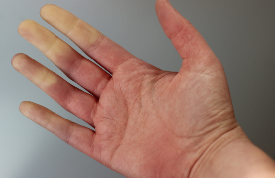 The Connection: Raynaud’s phenomenon and Fibromyalgia