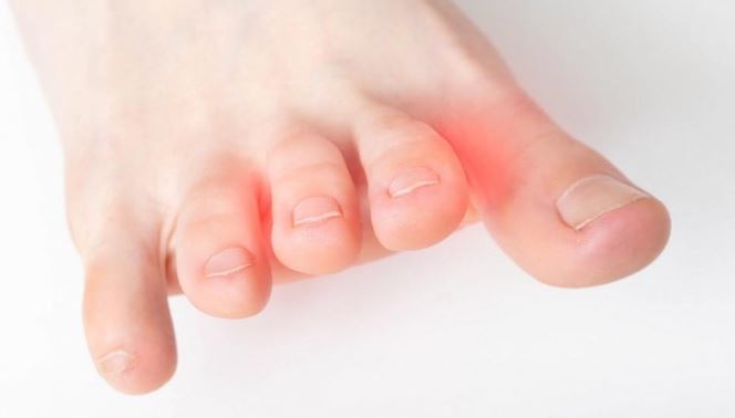 Arthritis in Your Toes: Signs of Toe Arthritis, and What to Do About It