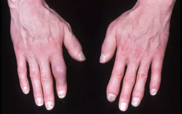 What Is Dactylitis? The ‘Sausage Finger’ Swelling You Should Know About