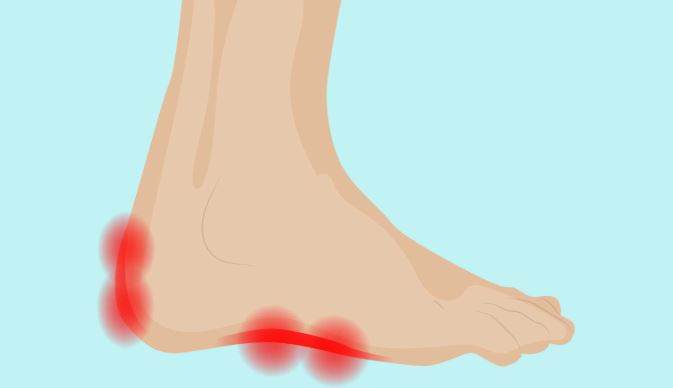 What Is Enthesitis? The Painful Arthritis Symptom You Should Know About