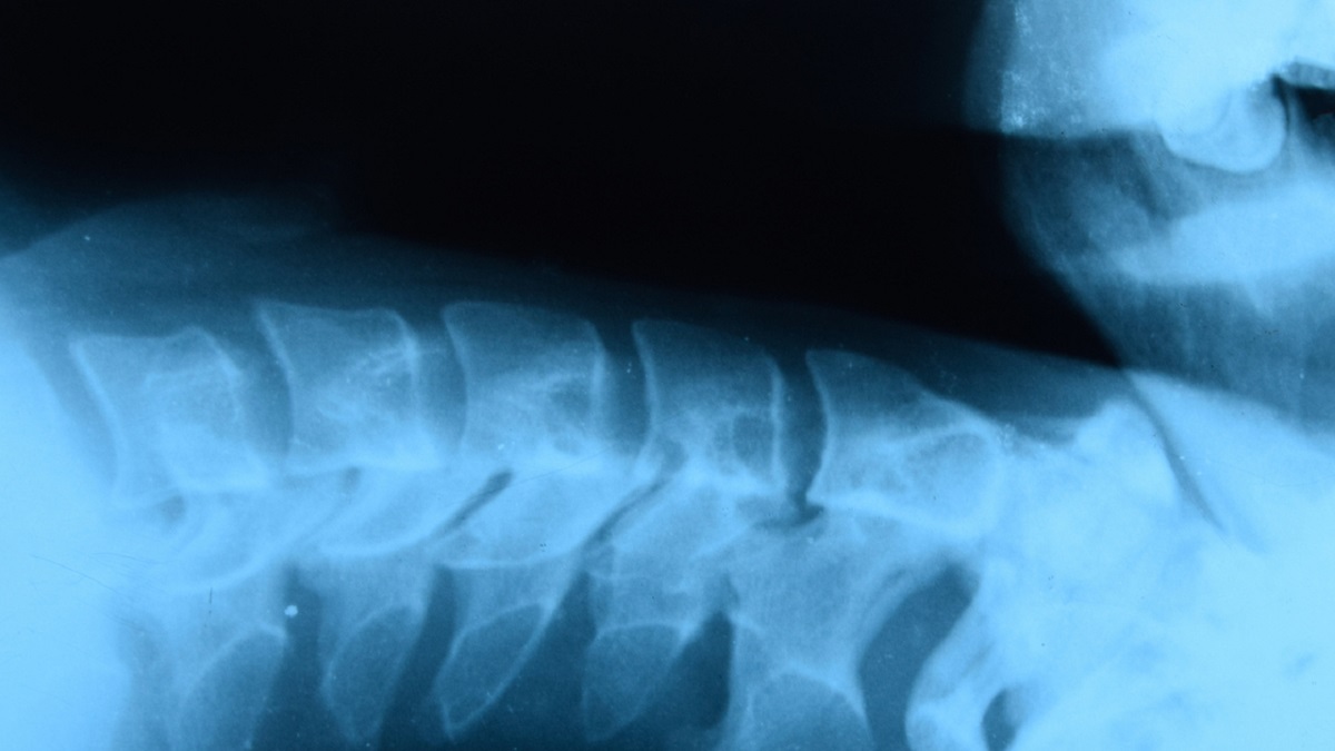 Fibromyalgia and Ankylosing Spondyloarthritis