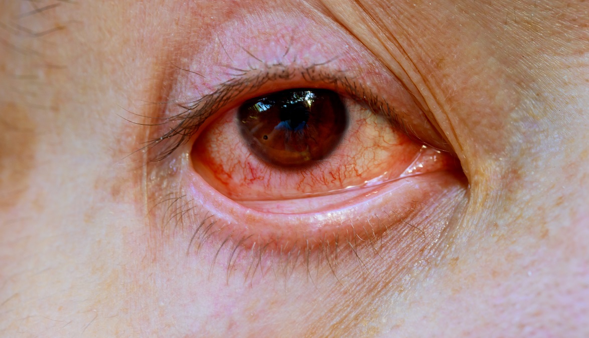 How Does CRPS Affect The Eyes?