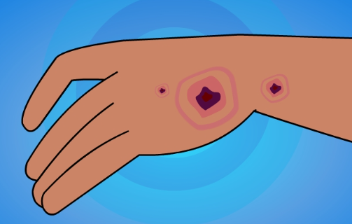 Slow Healing in Fibromyalgia: Why Wounds and Injuries Take Longer to Recover